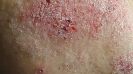 Pacjenci z AZS apelują do Ministra Zdrowia o dostęp do skutecznej terapii Zdrowie, LIFESTYLE - Mimo że sytuacja pacjentów z najcięższą postacią AZS jest wyjątkowo trudna, to nadal pierwsza i jak na razie jedyna zarejestrowana w Unii Europejskiej substancja czynna stosowana w najcięższych postaciach AZS ze względu na brak refundacji nie jest dla pacjentów dostępna.