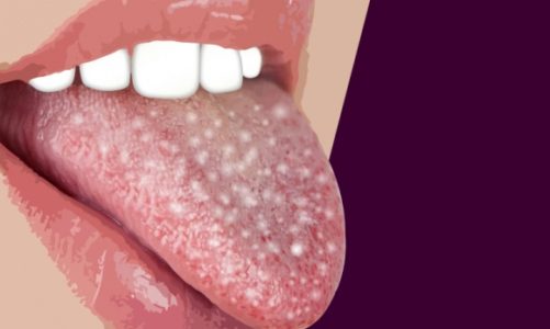 Biały nalot, ból i dyskomfort w jamie ustnej? Sprawdź czy to coś poważnego!
