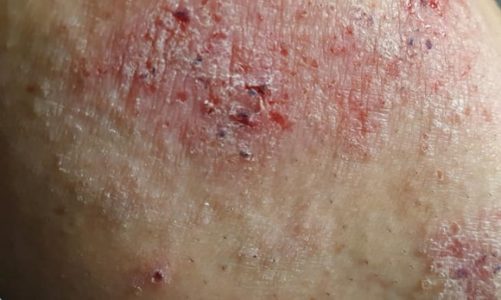 Ile państwo wydaje na nieskuteczne leczenie pacjentów z AZS?